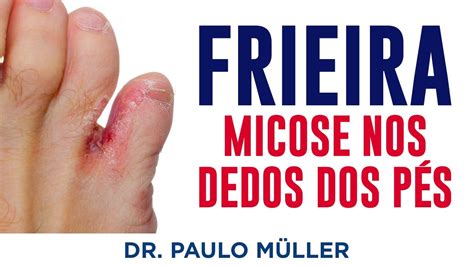 Frieira Micose Entre os Dedos do Pé Dr Paulo Müller Dermatologista