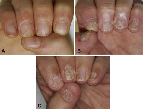 Isolated Nail Lichen Planus An Expert Consensus On Treatment Of The