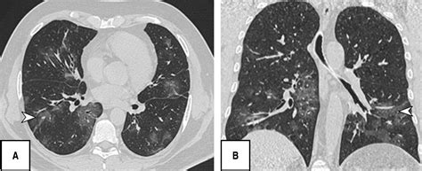 Clinical and chest imaging characteristic in patients with COVID-19 in ...