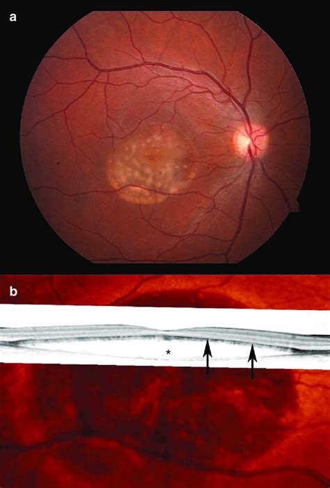 Moderate Vitelliform Macular Degeneration Vmd Moderate Phenotypic Download Scientific