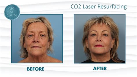 Laser Resurfacing Peel Face And Mouth YouTube