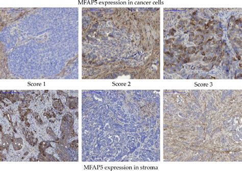 Immunohistochemical Detection Of Mfap In Oc Samples Upper