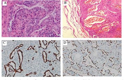 Figure 1 From Pulmonary Sclerosing Hemangioma With A Rare Symptom A