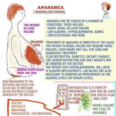 An Overview Of Anasarca Quiz Questions