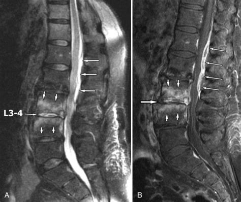 Epidural Abscess | Radiology Key