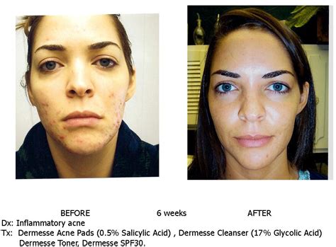 Glycolic Acid Before And After Photos