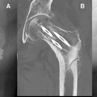 PDF Internal Fixation Of Intracapsular Femoral Neck Fractures In