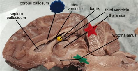 Brain Corpus Callosum And Ventricles