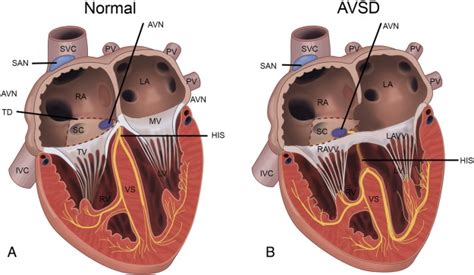 Atrioventricular Septal Defect From Embryonic Development To Long Term