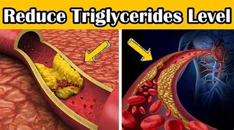 Effect Of Triglycerides On Overall Health And Risk Factors Onlymyhealth