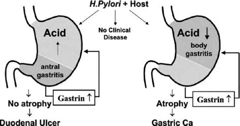 The Relationship Between The Pattern Of Gastritis Induced By H Pylori