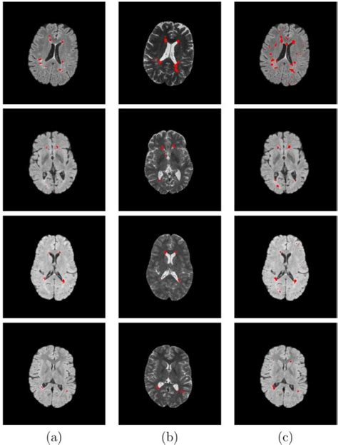 [pdf] Automatic Multiple Sclerosis Lesion Segmentation Using Patch Wise R Cnn Semantic Scholar