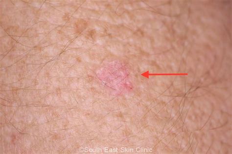 BCC (Basal Cell Carcinoma)