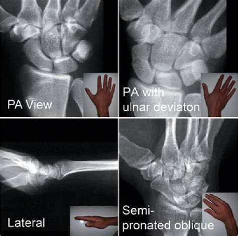 Figure 1 From Review Of Imaging Of Scaphoid Fractures Semantic Scholar