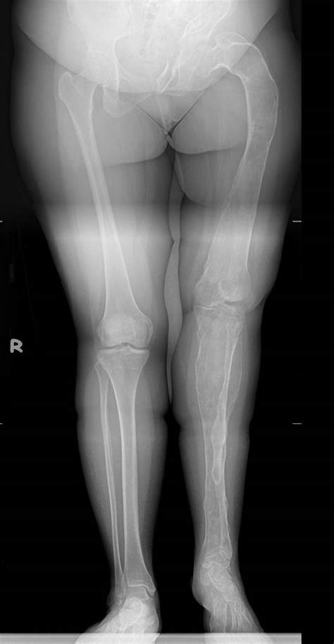 Polyostotic Fibrous Dysplasia Radiology Cases