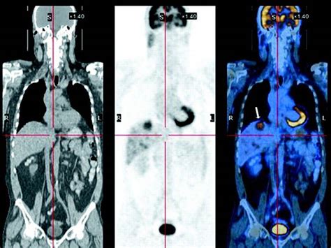 PET CT Scan Vs CT Scan For Cancer Diagnosis