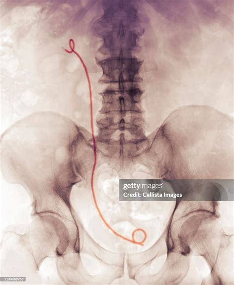 Xray Showing A Ureteral Stent High Res Stock Photo Getty Images