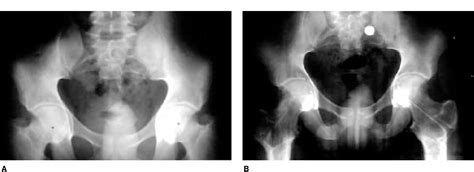 Figure From Protrusio Acetabuli Diagnosis And Treatment Semantic