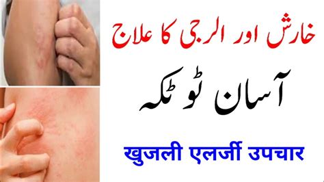 Jism Ki Kharish Aur Allergy Khatam Karne Ka Asan Tarika Skin Allergy