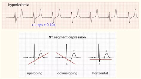 Abnormalities of t wave | PPT