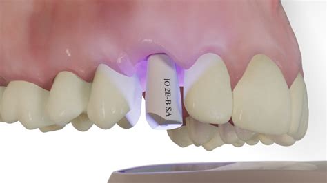 Trios Invisalign Integration Esm Digital Solutions