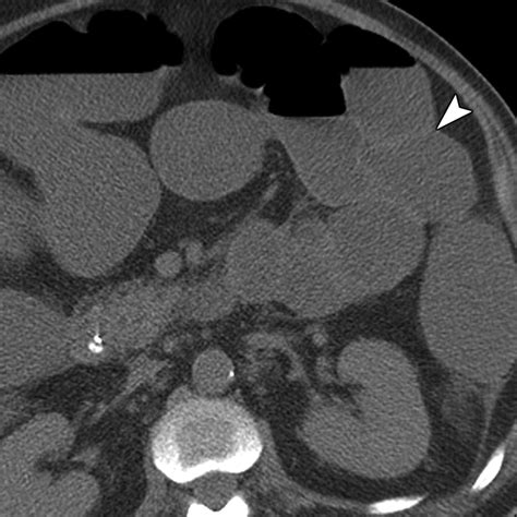 Ultrasound Imaging Of Bowel Pathology Technique And Keys To Diagnosis