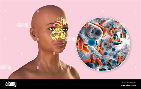 Sinusitis Inflammation Of Paranasal Cavities Computer Illustration