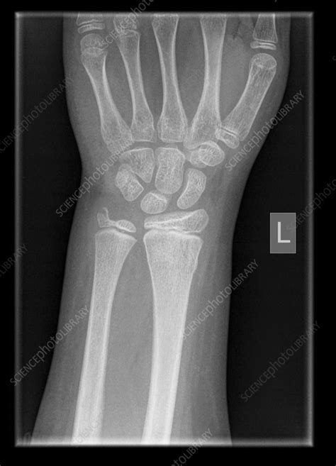 Distal Radius And Ulna Fractures X Ray Stock Image C056 4213