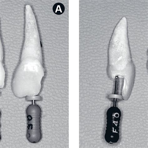 Location Of The Apical Foramen In Relation To The Root Apex A Apical