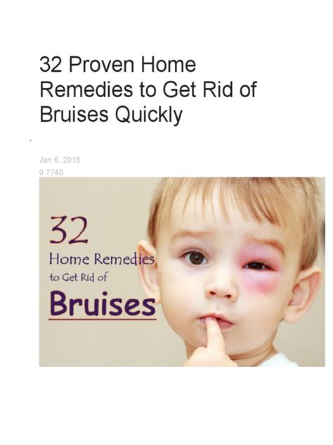 32 Proven Home Remedies To Get Rid of Bruises Quickly | PDF | Chocolate ...