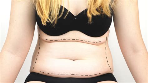 Perfect Tummy Tuck