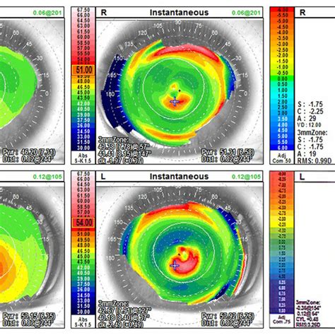 Corneal Topography In The Left Eye At Presentation 3 Years After