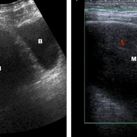 Pelvic Ultrasound Reveals A Heterogeneous Hypoechoic Mass Adjacent To