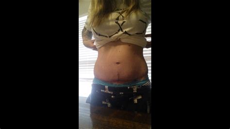 5 Week Post Op Tummy Tuck Youtube