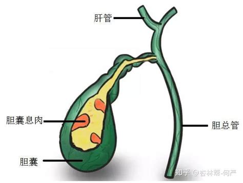 胆囊息肉，你离胆囊癌有多远？——黄安华胆病科普系列 知乎