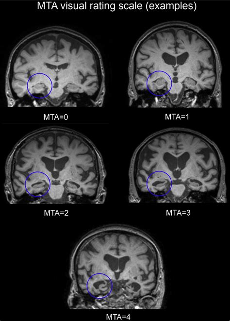 Multimodal Eeg Mri In The Differential Diagnosis Of Alzheimers Disease