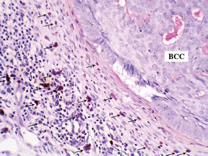 Toluidine Blue Stain Showing Accumulation Of Mast Cells With Dark Blue