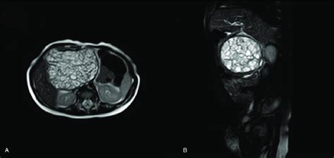 A B Preoperative Mri Scan Of The Pediatric Pancreatic Teratoma