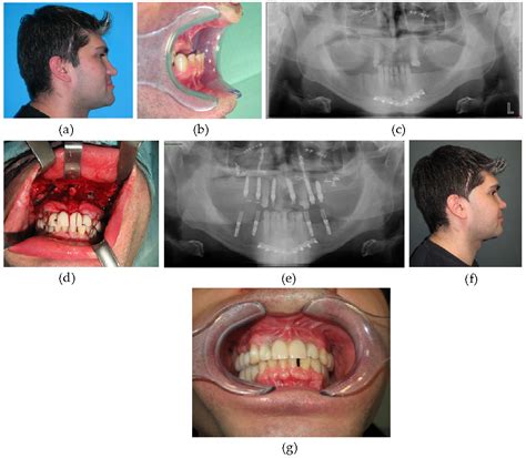 Basic And Advanced Operative Techniques In Orthognathic Surgery