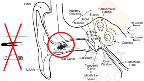 Insect In The Ear Basic First Aid Ent Specialist In Gurgaon Dr