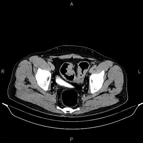 Ulcerative Colitis Image Radiopaedia Org