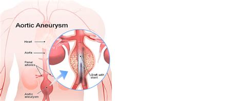 Symptoms help in the Diagnosis of an Abdominal Aortic Aneurysm