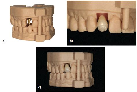 Immediate Implant Placement In Extraction Socket With An Adapted