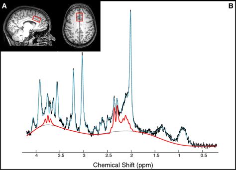 Glutamate Levels In The Anterior Cingulate Cortex Acc A Location