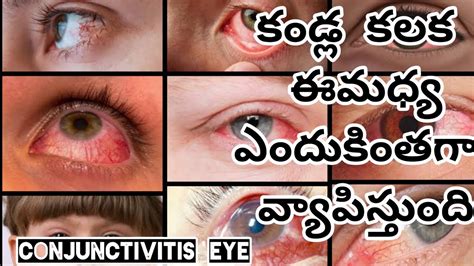 Conjunctivitis Eye