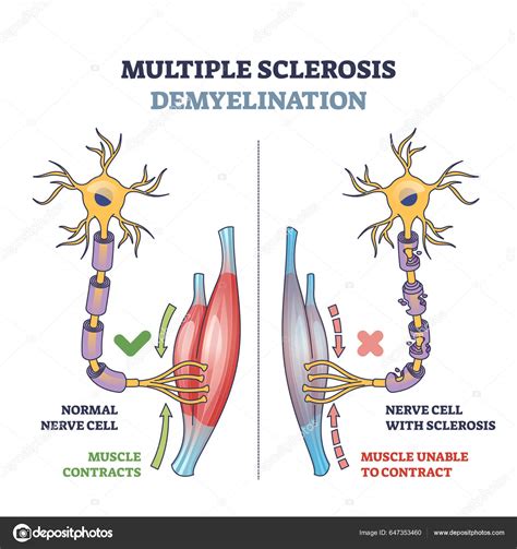 Desmielinización Esclerosis Múltiple Comparación Con Los Nervios Sanos