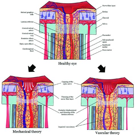 Cross section of the optic nerve in the healthy (top) and the ...