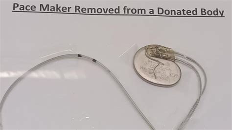 Removal Of Pacemaker From A Dead Body Youtube