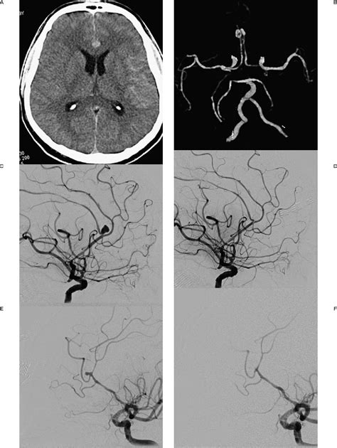 Figure 2 From Mirror Image Distal Anterior Cerebral Artery Aneurysms Treated With Coil