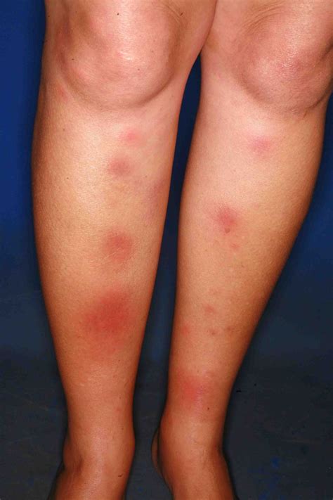 Erythema Nodosum Leprosum Leprosy Erythema Nodosum Skin